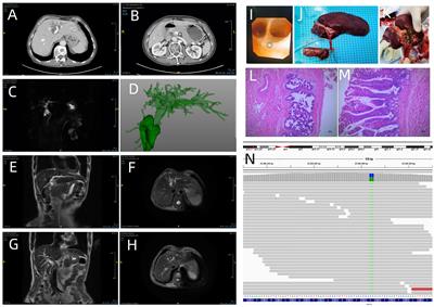 Surgical Treatment of Intraductal Papillary Neoplasm of the Bile Duct: A Report of Two Cases and Review of the Literature